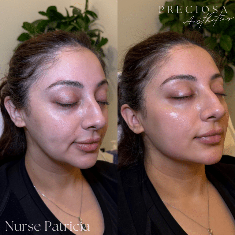 Facial Balancing with Dermal Fillers