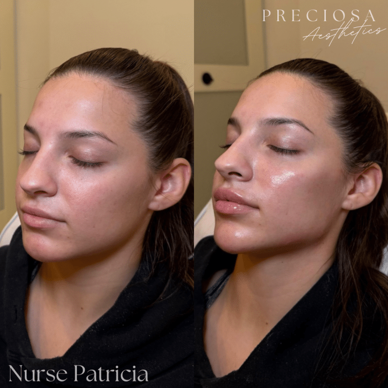 Facial Balancing with Dermal Fillers